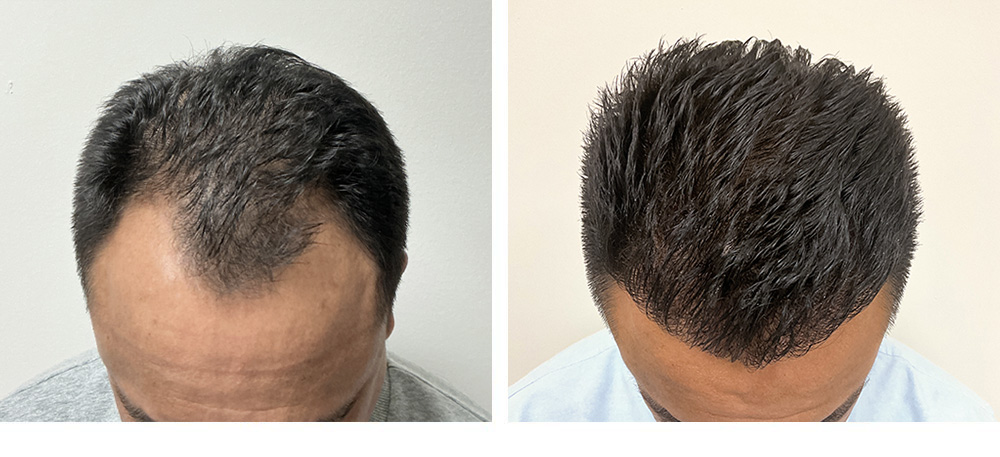 Hair Transplant Before and After