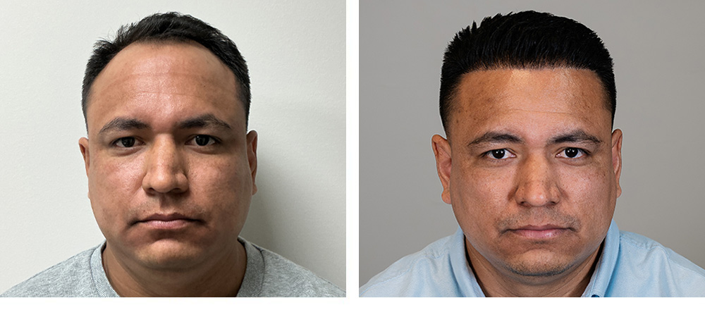 Hair Transplant Before and After