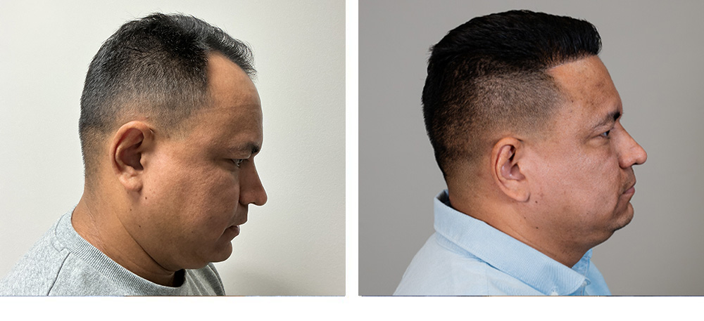 Hair Transplant Before and After