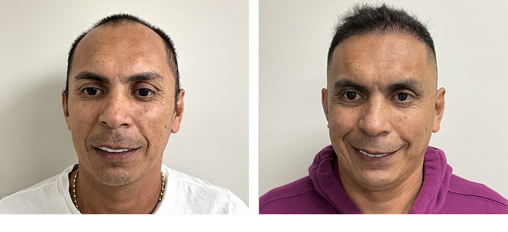 Hair Transplant Before and after