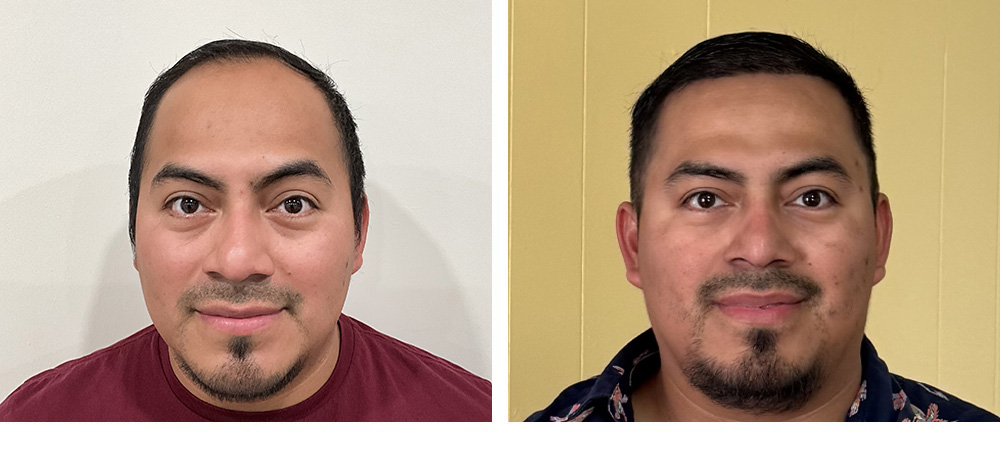 Hair Transplant Before and After
