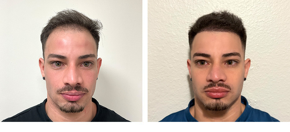 Hair Transplant Before and After