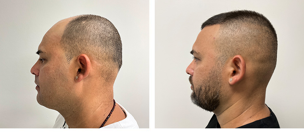 Hair Transplant Before and After