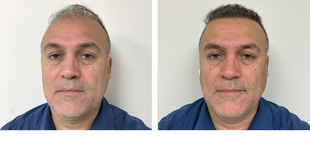 Hair Transplant Before and After