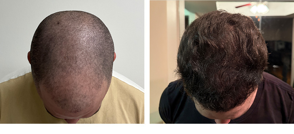 Hair Transplant Before and After