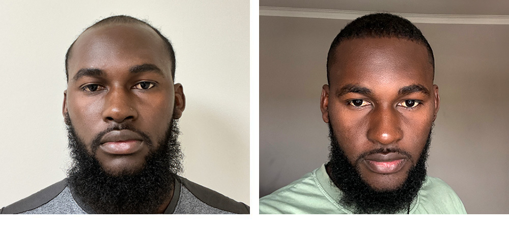 Hair Transplant Before and After