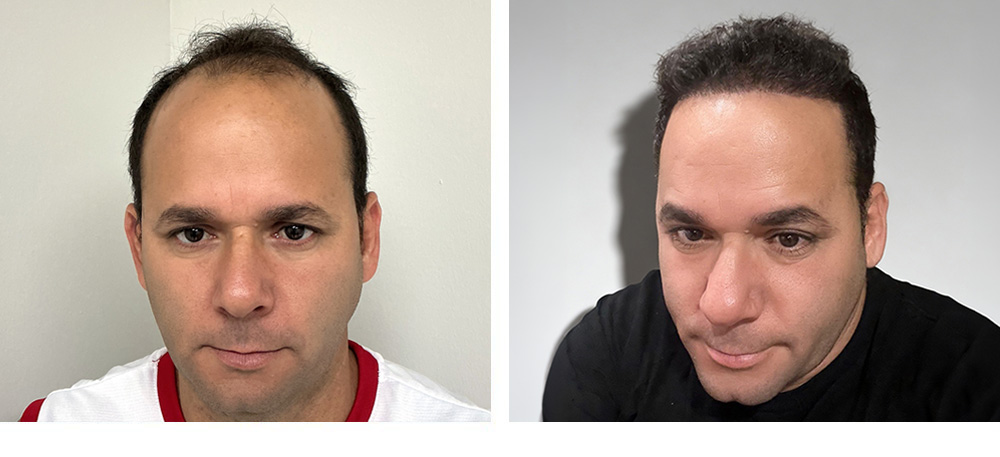 Hair Transplant Before and After