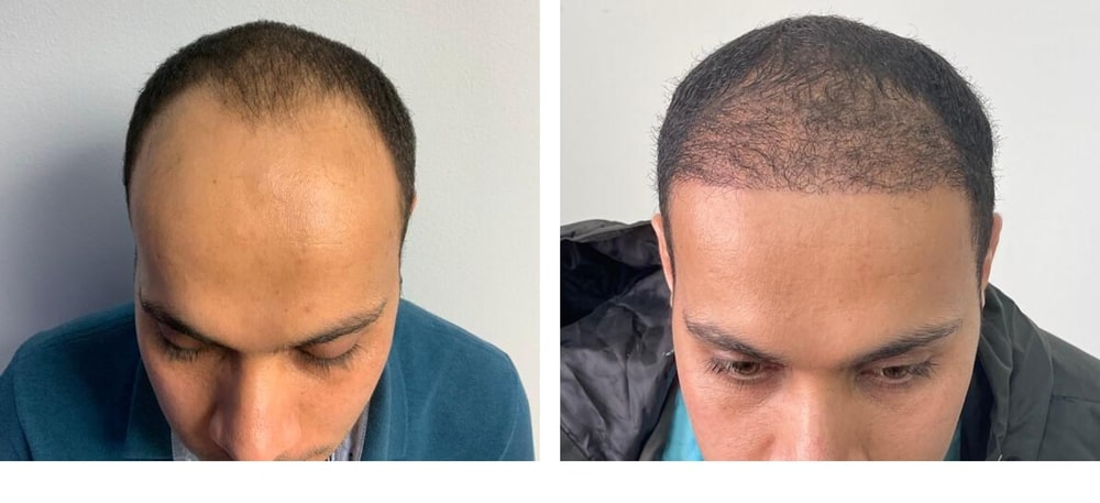 Hair Restoration Results Before and After