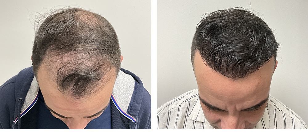 Hair Transplant Before and after in Miami