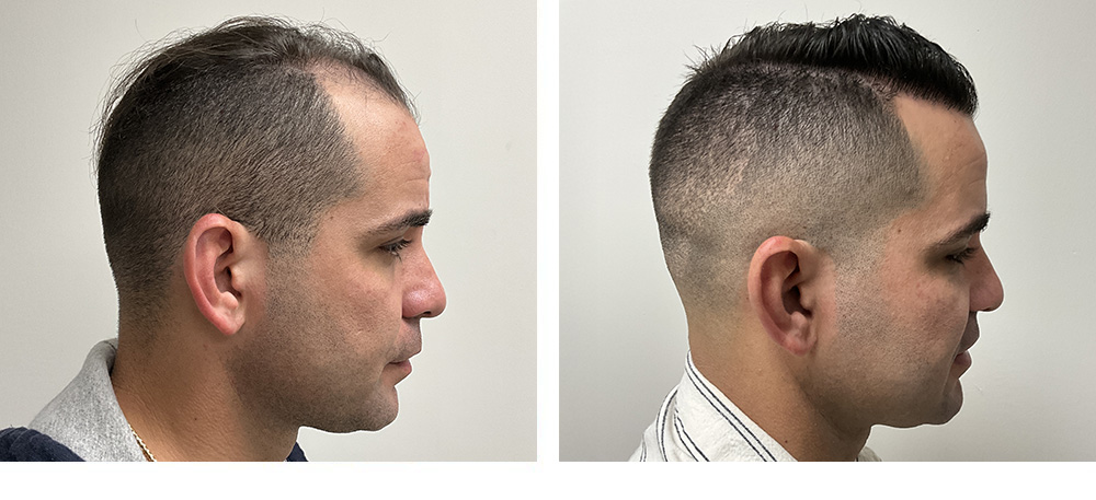 Hair Transplant Before and after in Miami