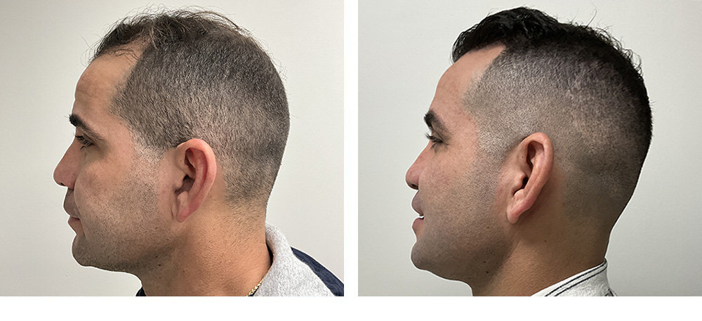 Hair Transplant Before and after in Miami