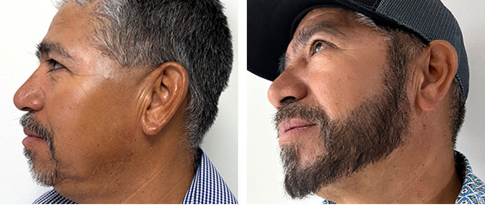 Beard Transplant Before and After
