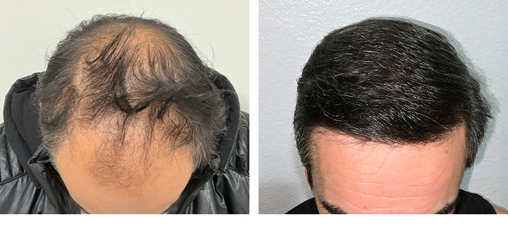 Hair Transplant Before and After