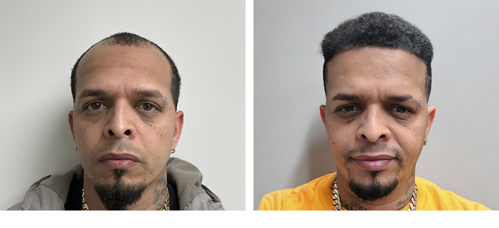 Hair Transplant Before and After