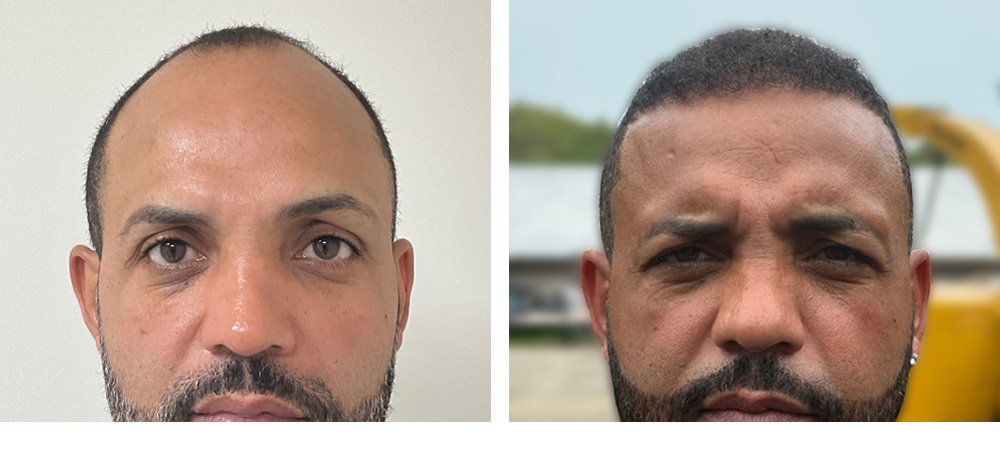 Hair Transplant Before and After