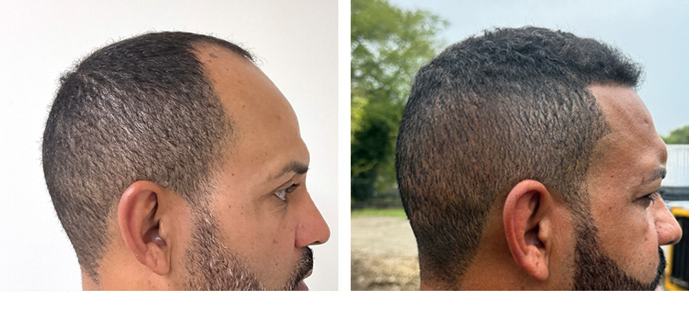 Hair Transplant Before and After