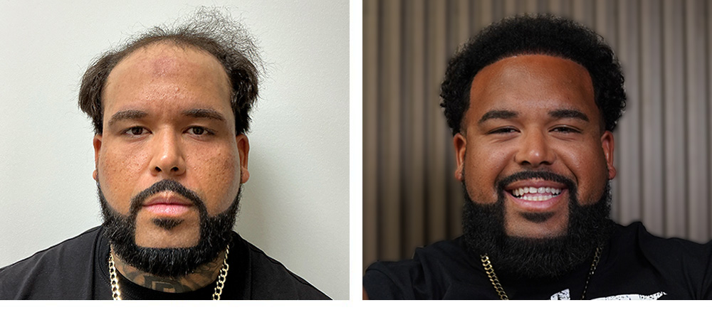 Hair Transplant Before and After