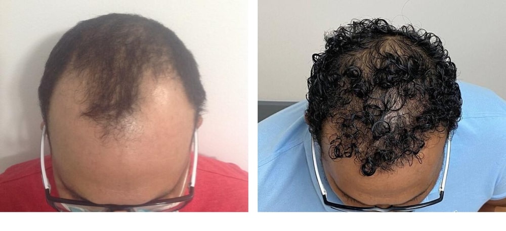 Hair Restoration Results Before and After