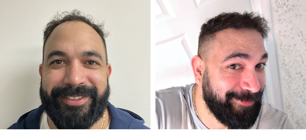 Hair Transplant Before and After