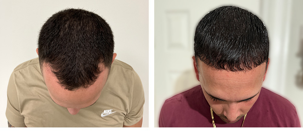 Hair Transplant Before and After
