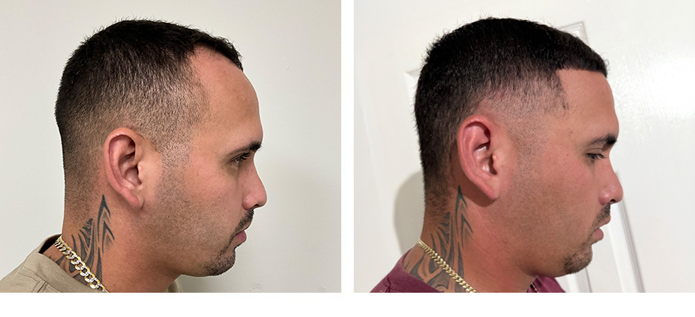 Hair Transplant Before and After