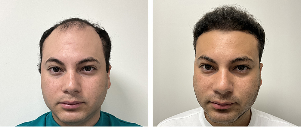Hair Transplant Before and After
