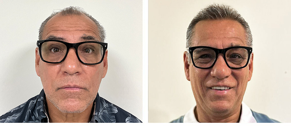 Hair Transplant Before and After