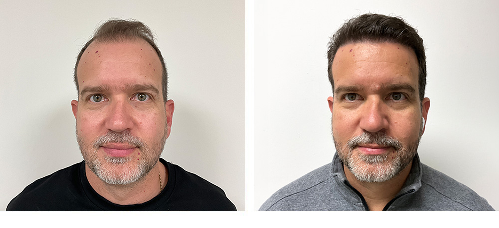 Hair Transplant before and after