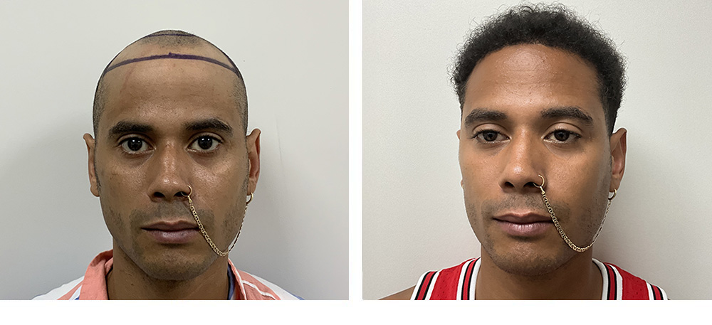 Hair Transplant Before and After