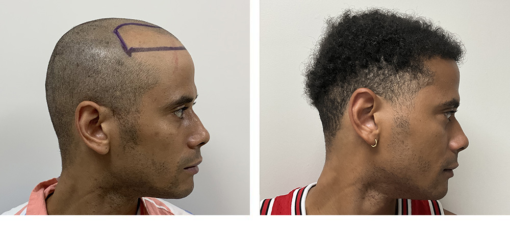 Hair Transplant Before and After