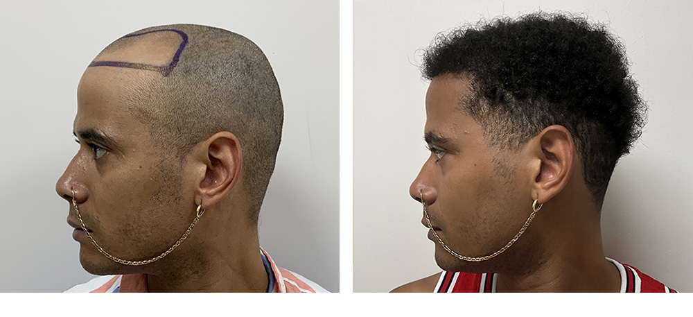 Hair Transplant Before and After