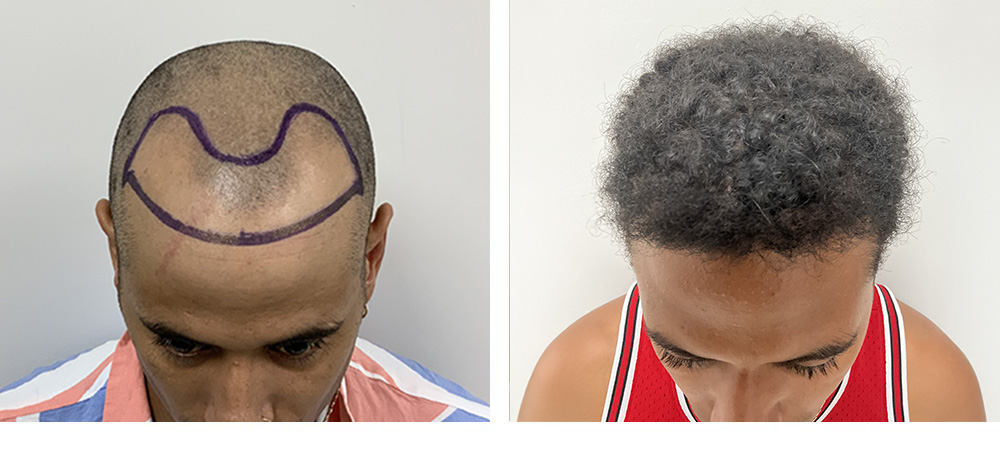 Hair Transplant Before and After