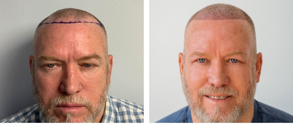 Hair Restoration Results Before and After