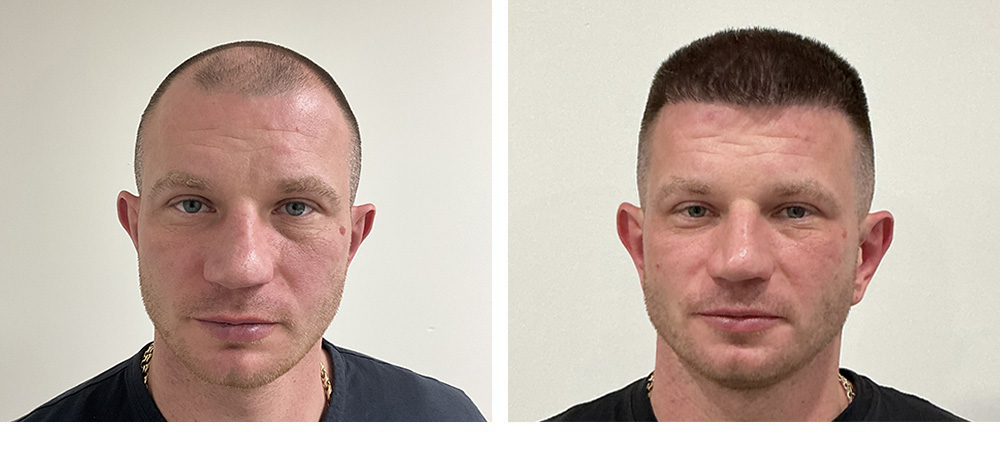 Hair Transplant Before and After