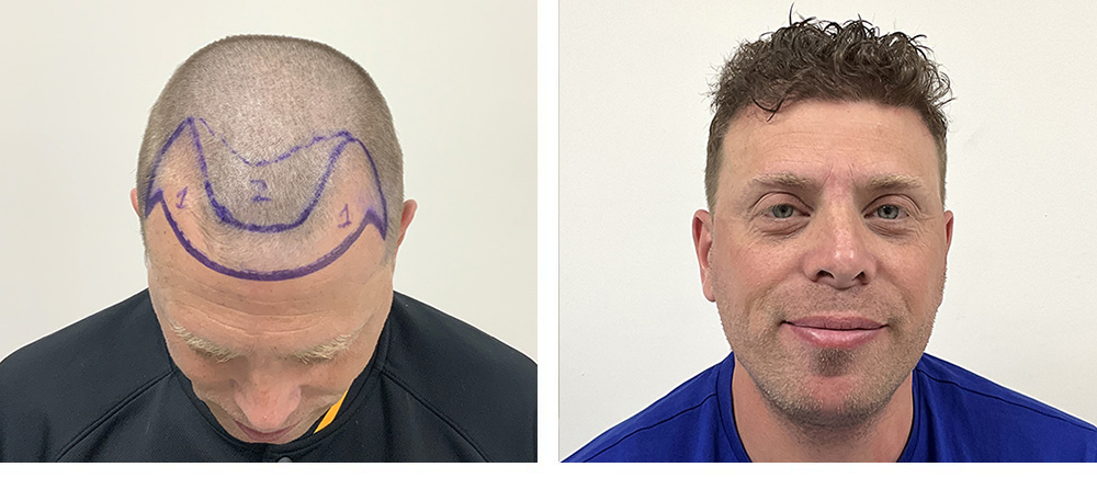 Hair Restoration Before and After