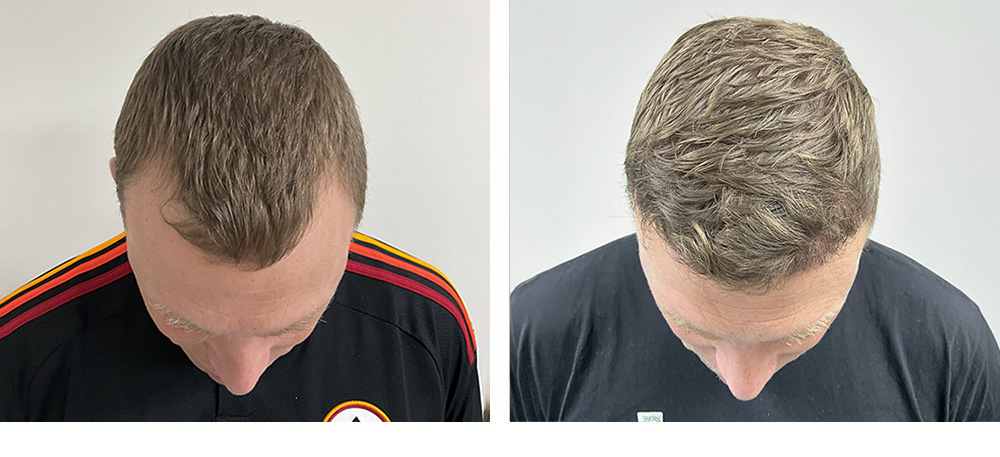 Hair Restoration Before and After