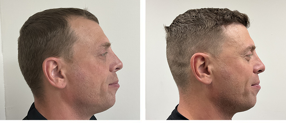 Hair Restoration Before and After