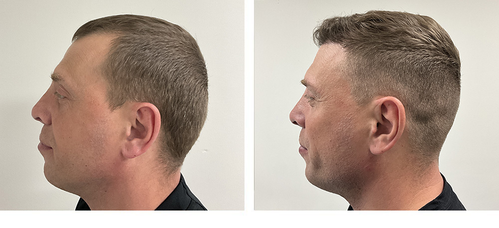 Hair Restoration Before and After