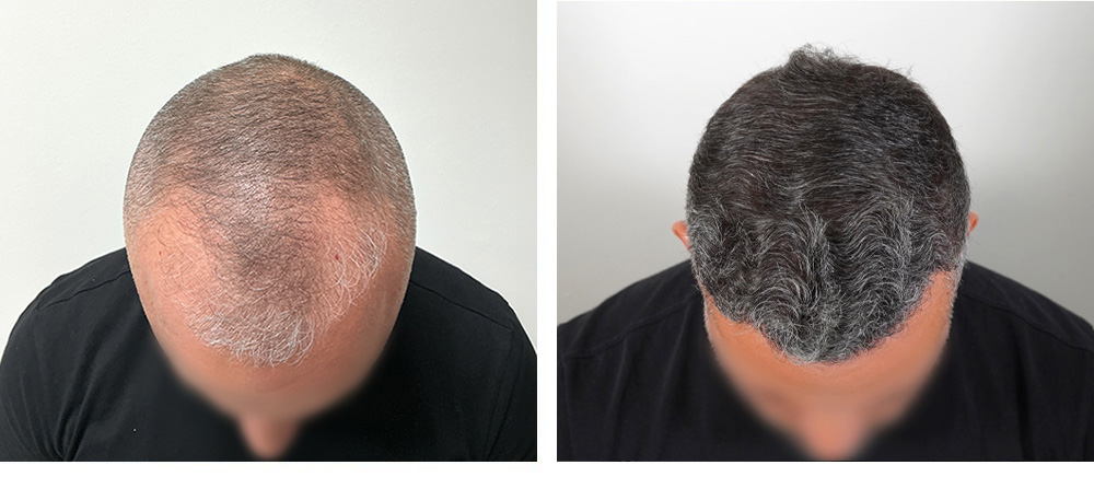 Hair Transplant Before and After