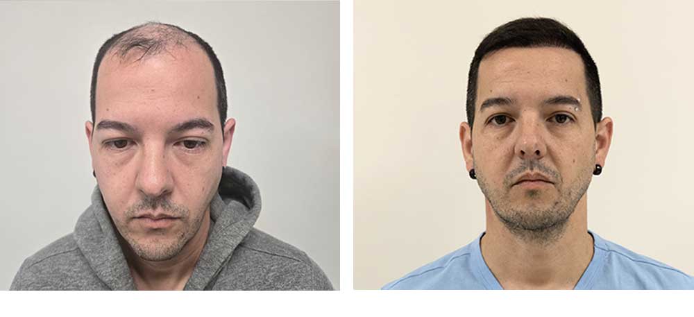 4000 grafts hair transplant before after
