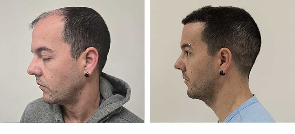 4000 grafts hair transplant before after