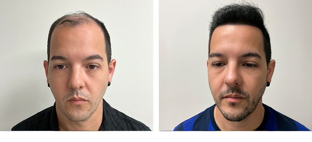 4000 grafts hair transplant before after