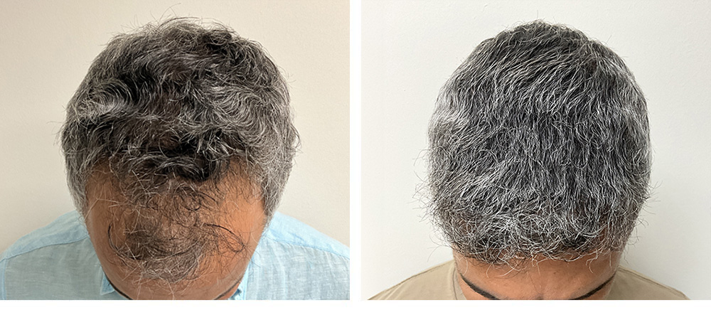 Hair Transplant Before and After