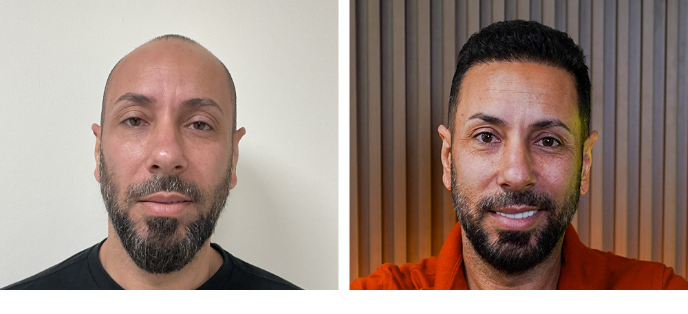 Hair Transplant Before and After