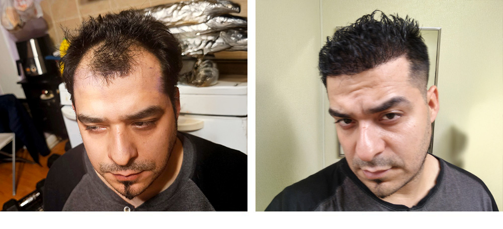 Hair Transplant Before and After