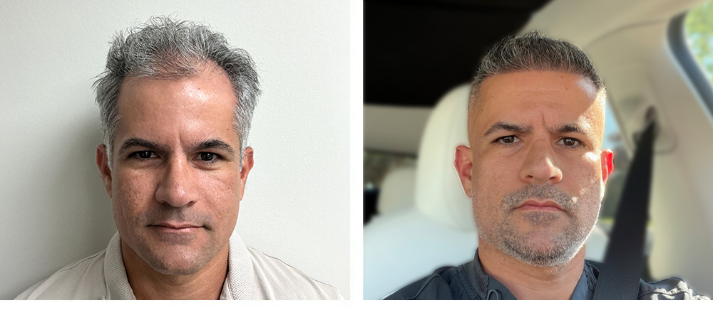 Hair Transplant Before and After