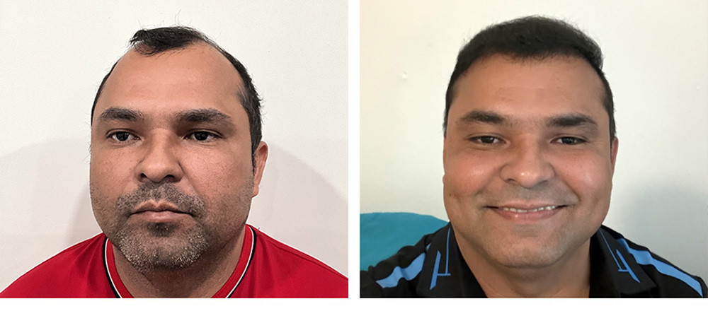 Hair Transplant Before and After