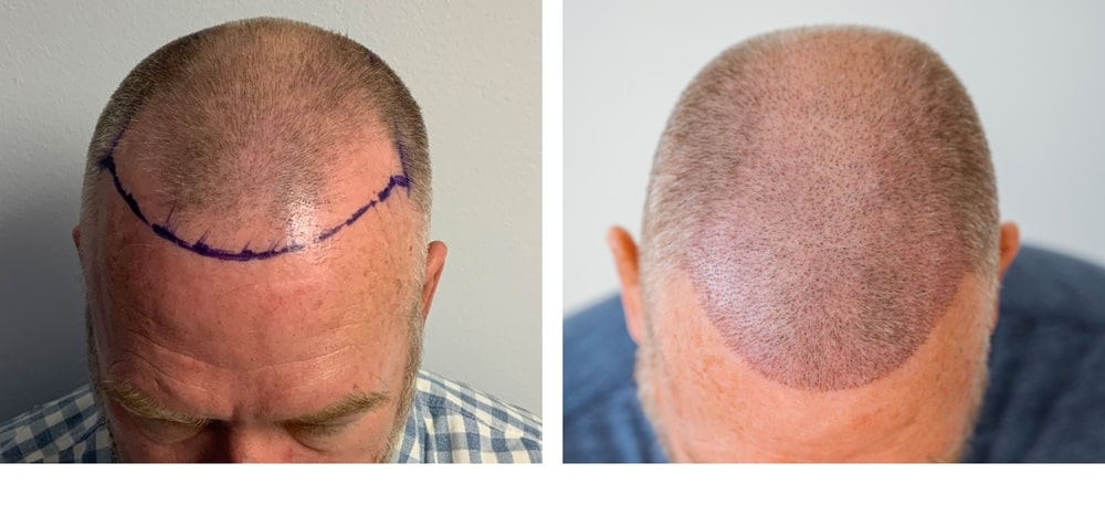 Hair Restoration Results Before and After