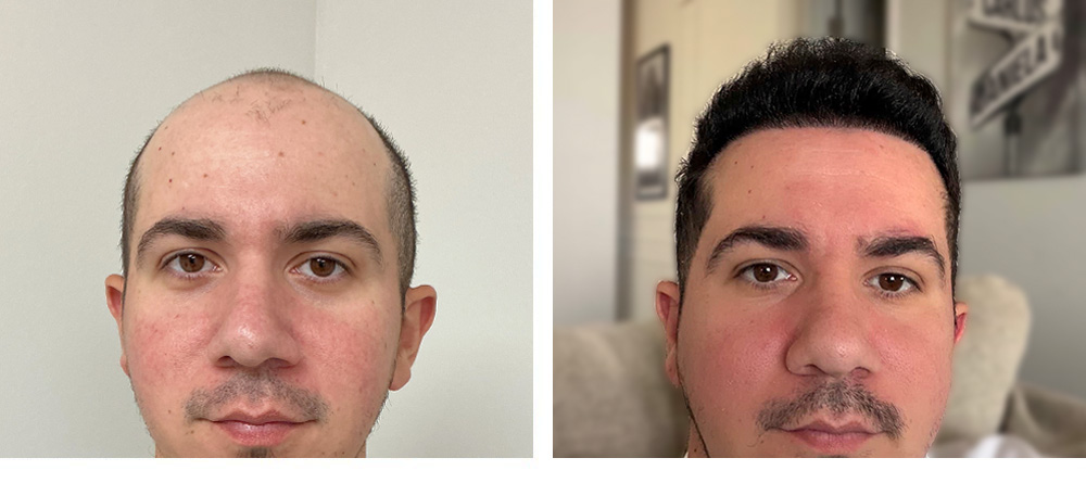 Hair Transplant Before and After