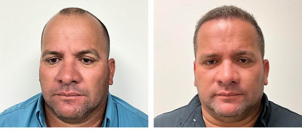 Hair Transplant Before and after